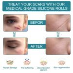Anubhav Janni Scar Remover Tape Silicone scar tape Scar Removal Sheet Strips For C Section Acne Scars Keloid Surgical Scars Reusable Medical Grade Tape Get Scars Away Painless (Pack Of 1 Pcs) - Image 3